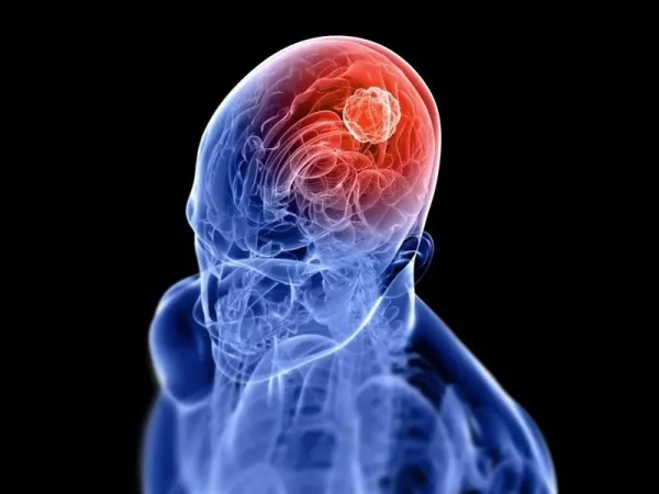 Brasil e França testam nova imunoterapia contra câncer no cérebro